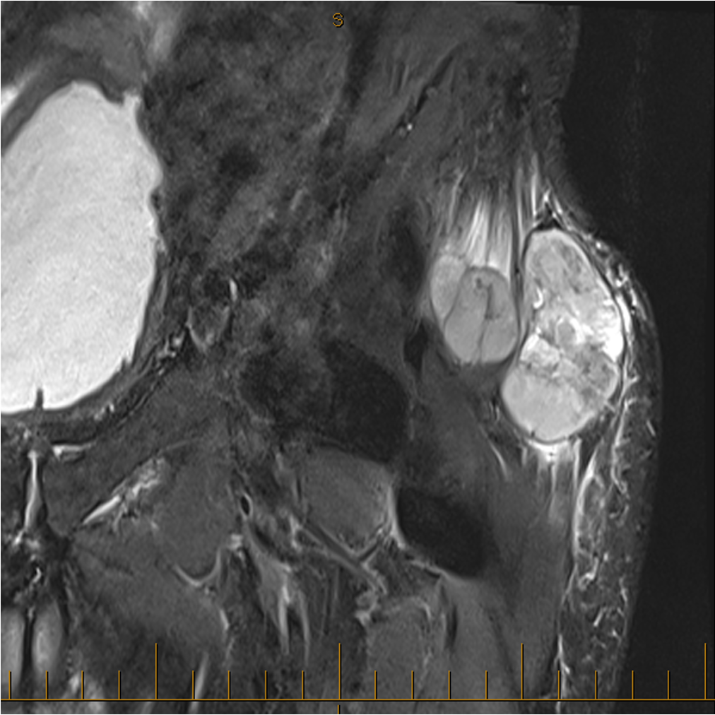 Hip sarcoma