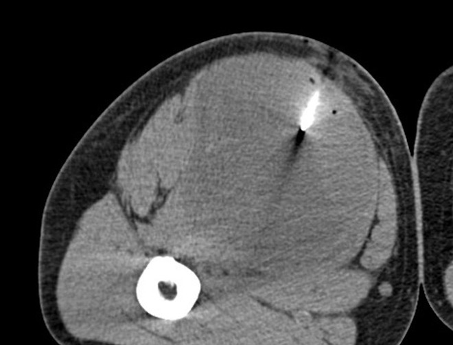 Sarcoma biopsy