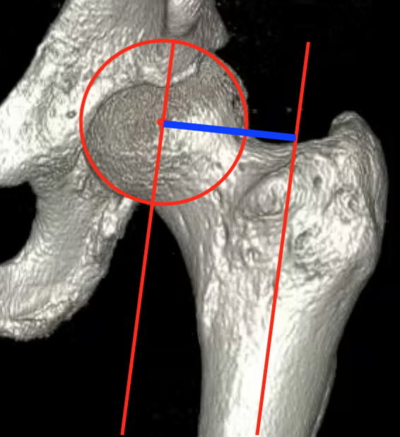 Femoral offset