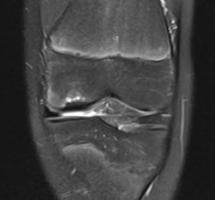 Stable lesion with cysts