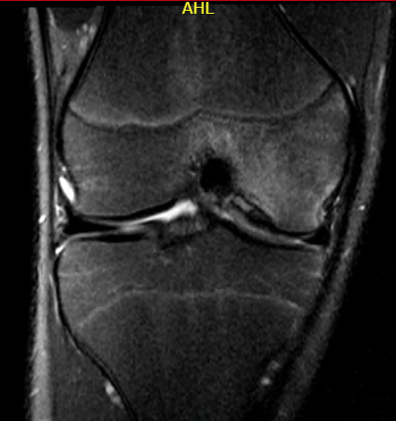 Stable OCD no cysts