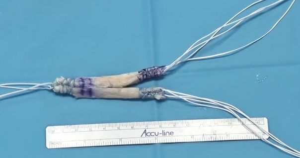 Double bundle PCL graft