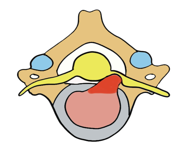 Cervical disc