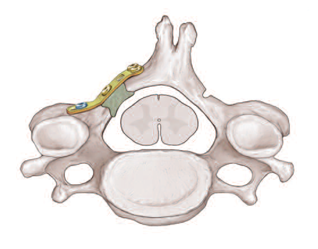 Laminoplasty 3