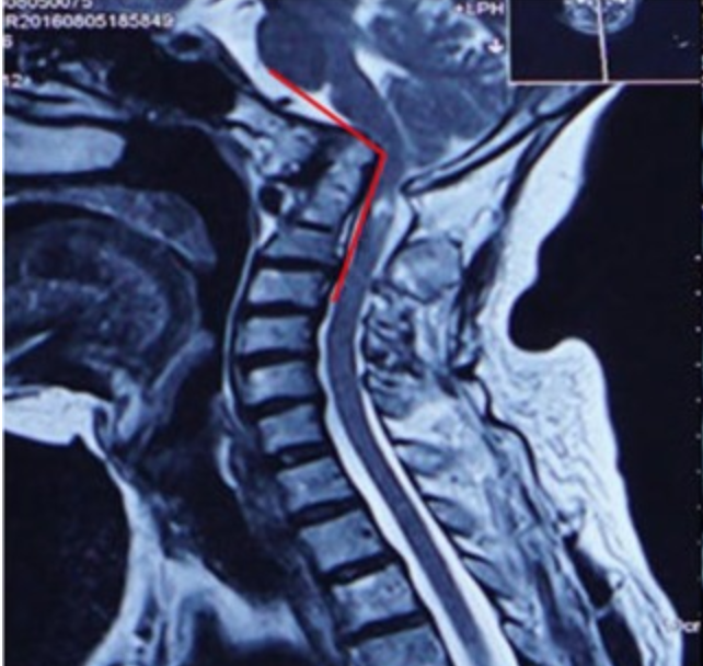 Cervicomedullary angle