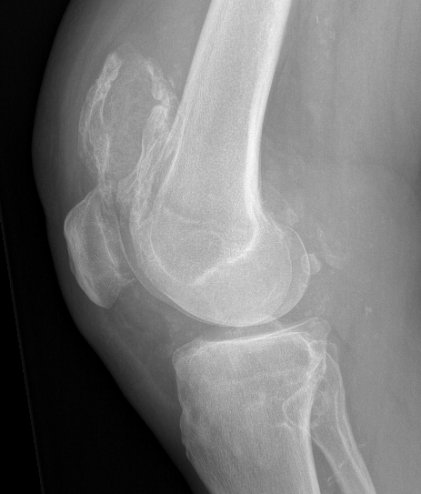 Knee syn osteo xray