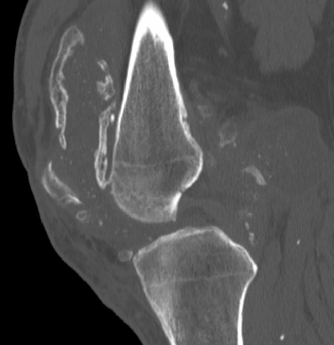 OC CT knee 1