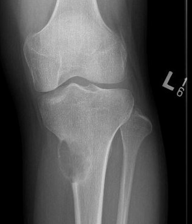 chondromyxoid fibroma 1