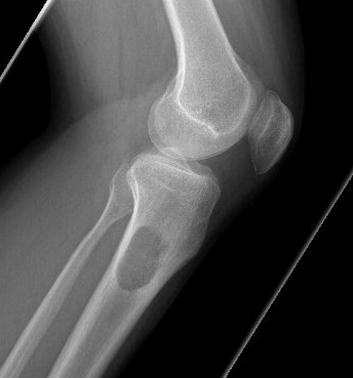 Chondromyxoid fibroma 2