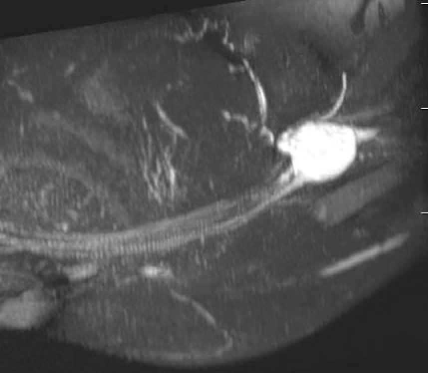 Neurofibroma