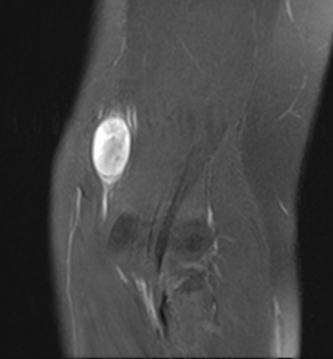 NF median 2