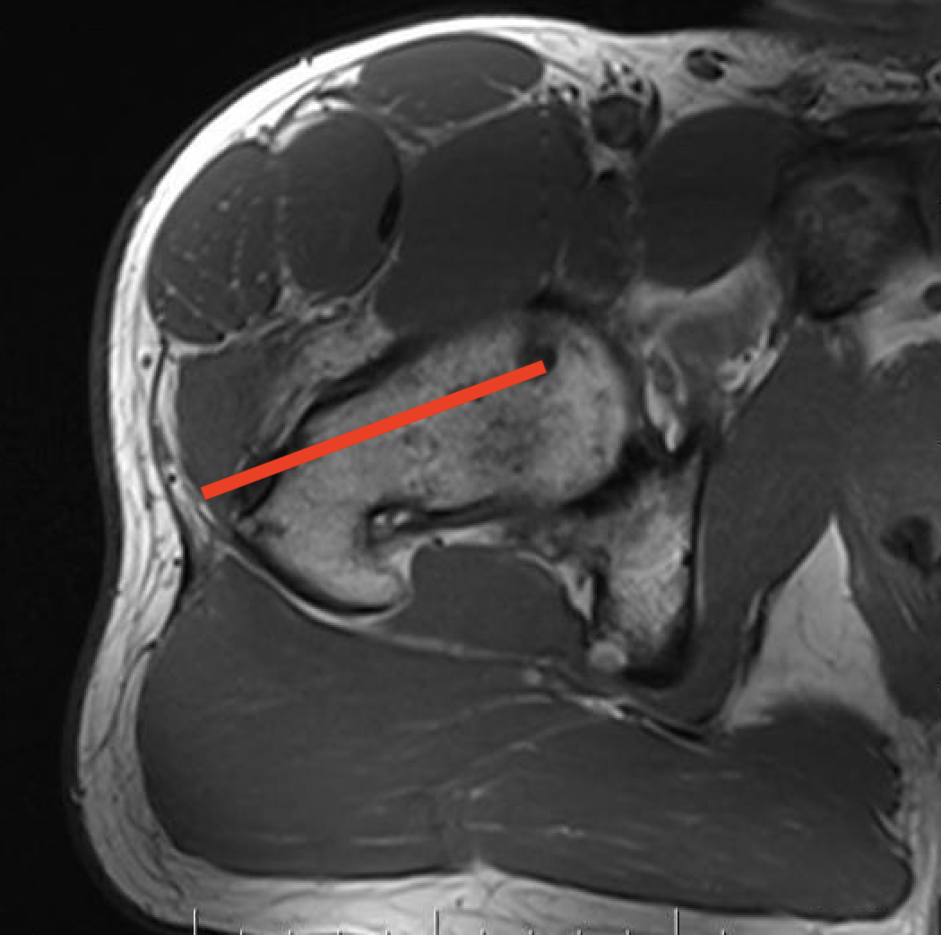 Fem neck biopsy