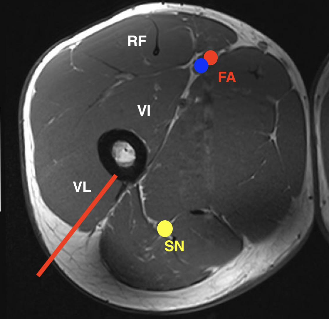 Femoral shaft biopsy