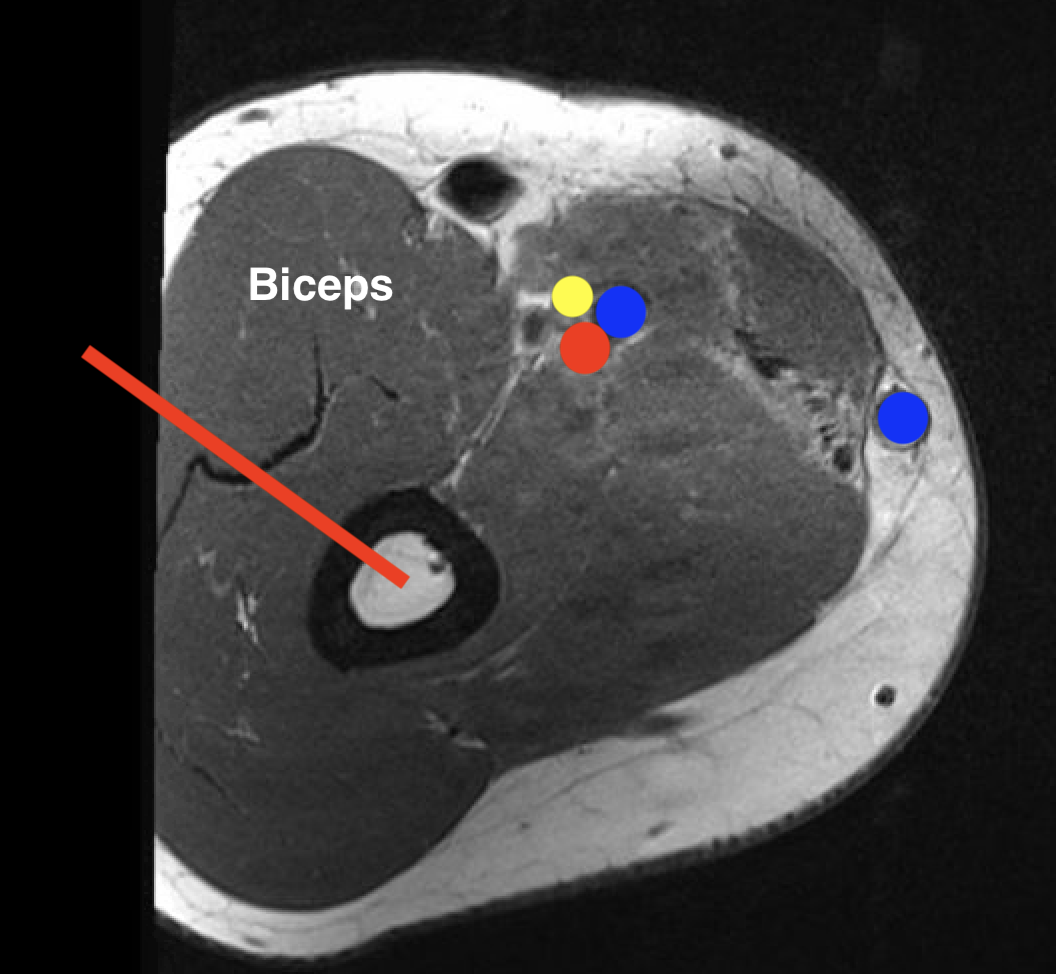 Humerus biopsy 2