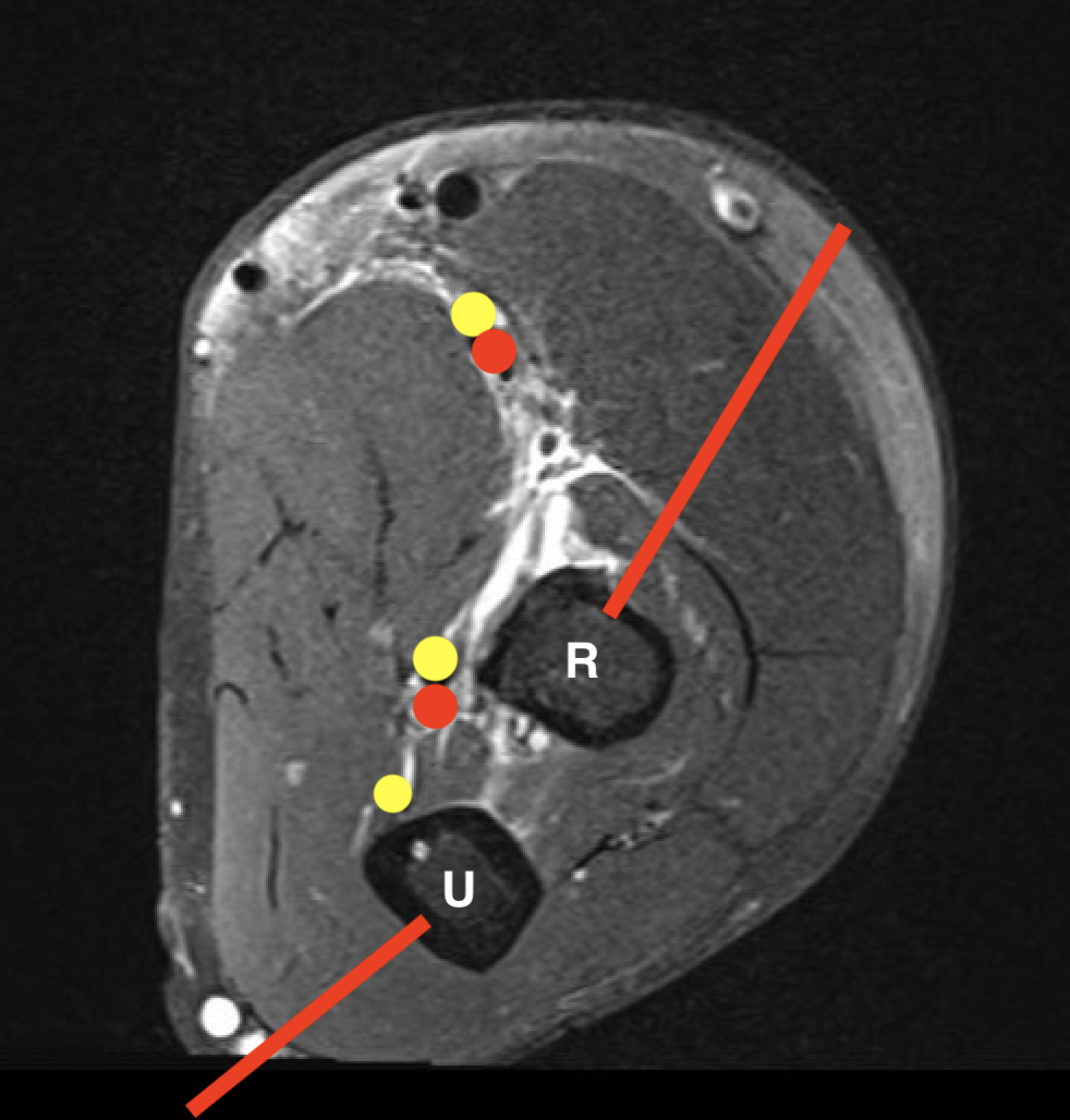 Ulna biopsy