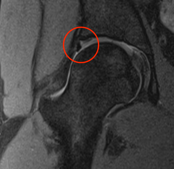 MRI labrum 2