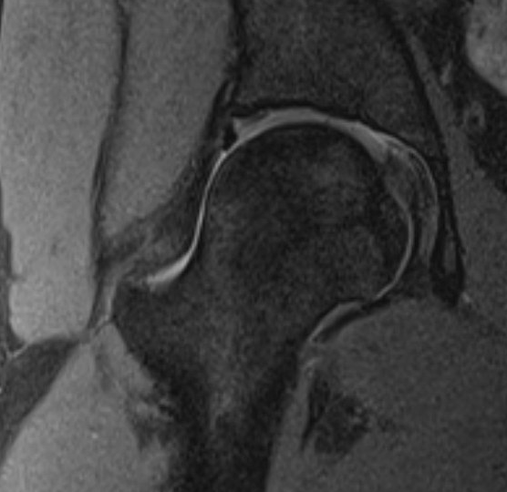 Mri labral 