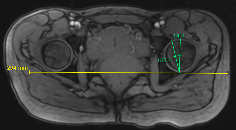 Acetabular version 2