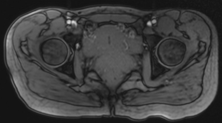 Acetabular version 1