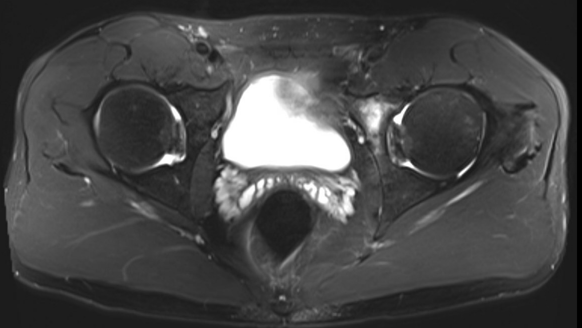 Acetabular version 1