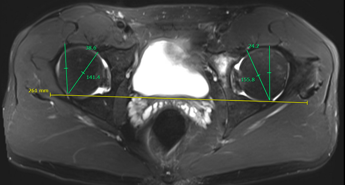 Acetabular version 2