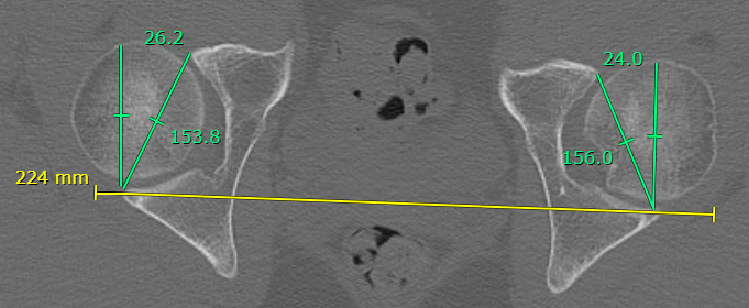 Acetabular version