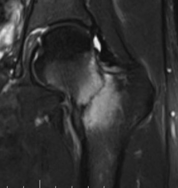 Femoral neck stress fracture MRI