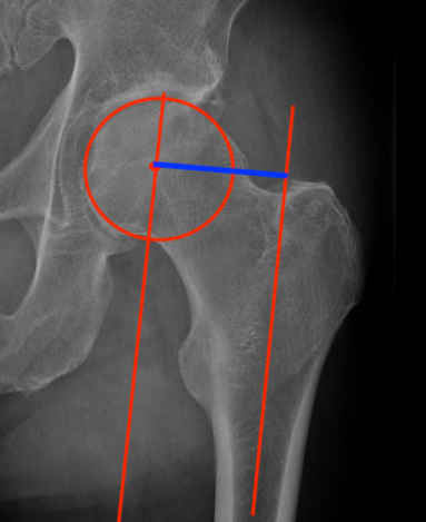 Femoral offset