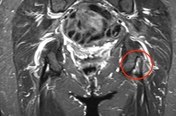 Tendinopathy