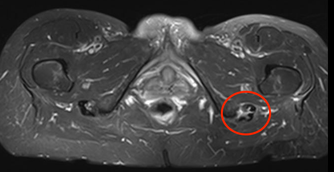 Tendinopathy