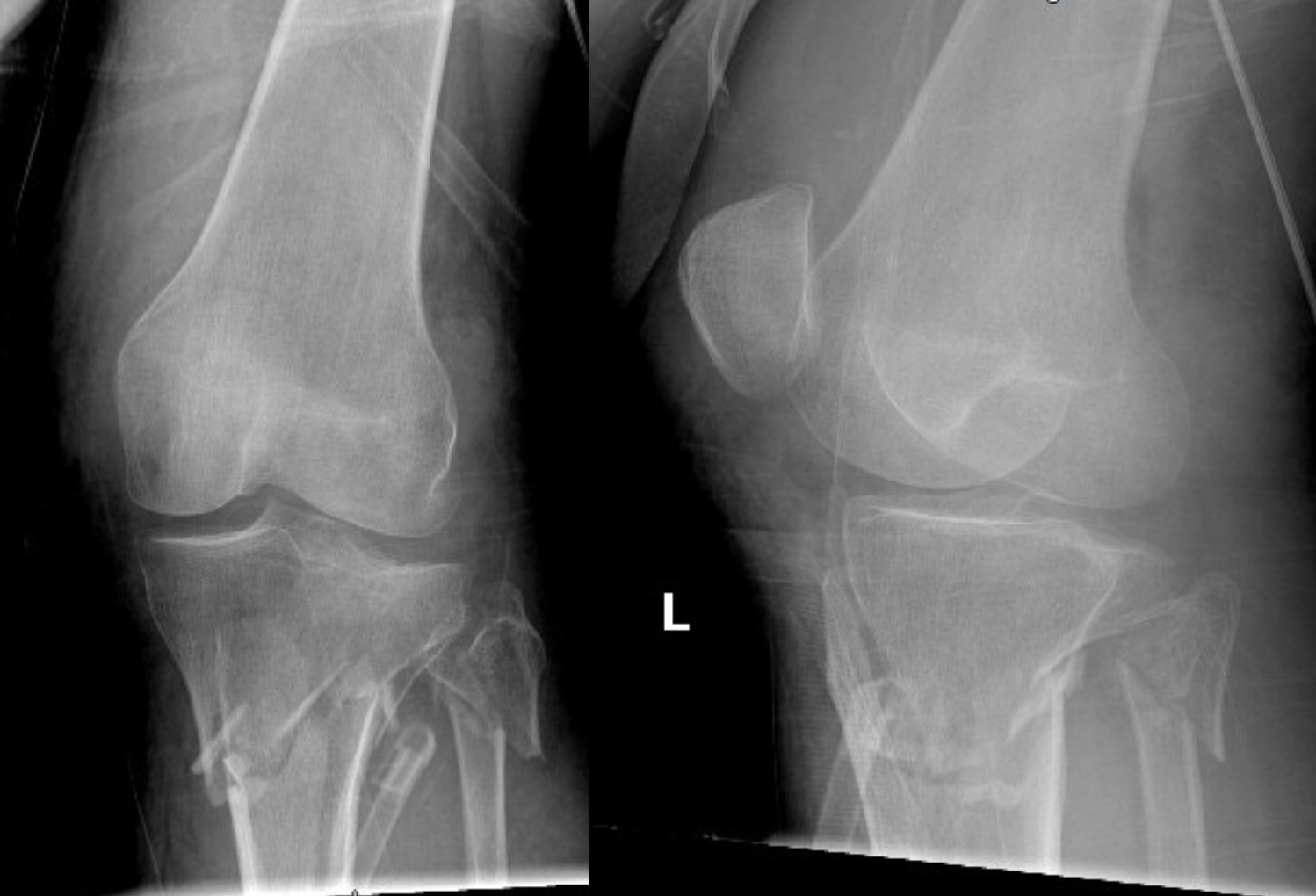 Proximal tibia #