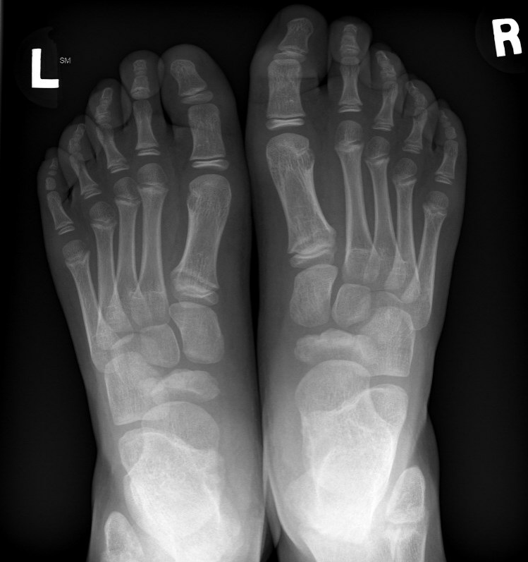 Kohlers disease