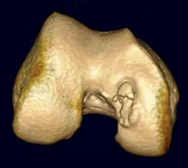 CT osteochondral defect