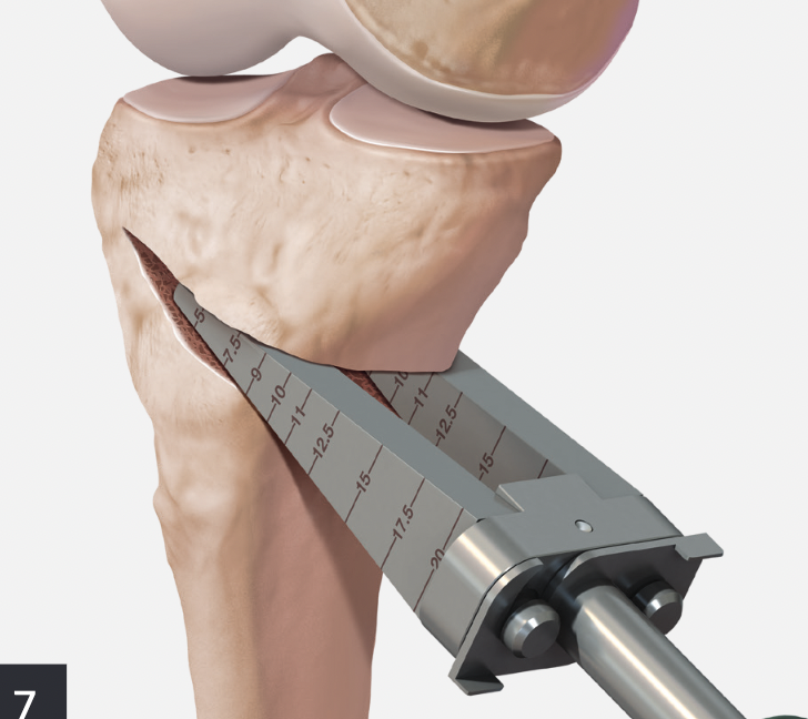 HTO osteotomy opening