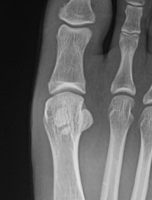 Fracture sesamoid