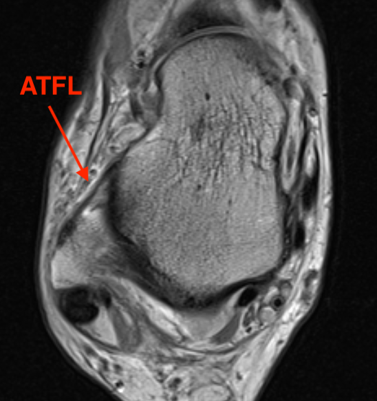 PTFL