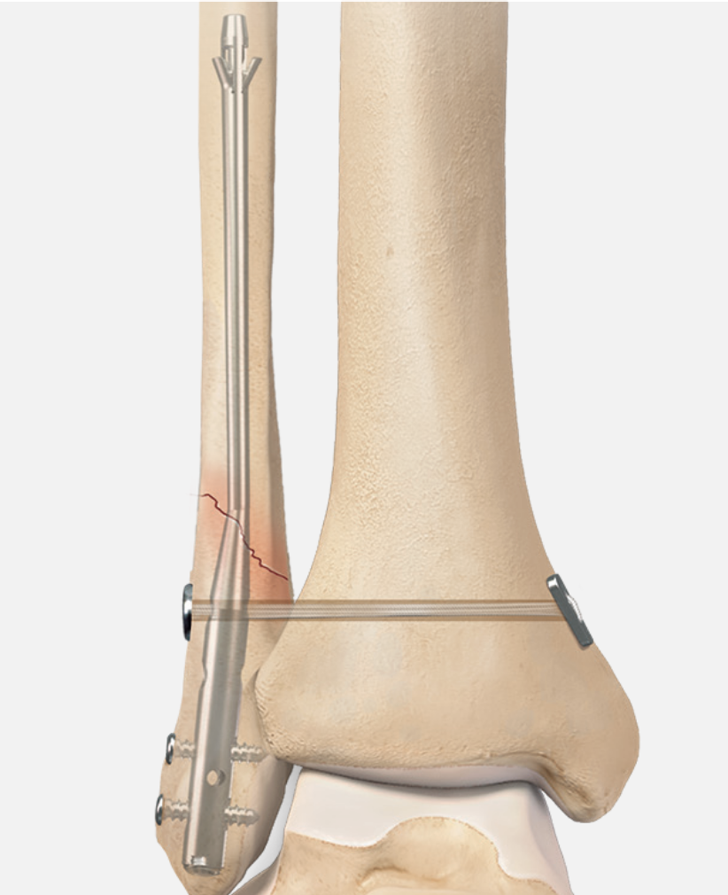 Arthrex fibular nail