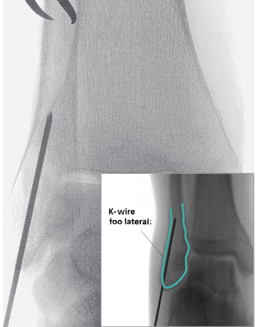 Arthrex fibular nail