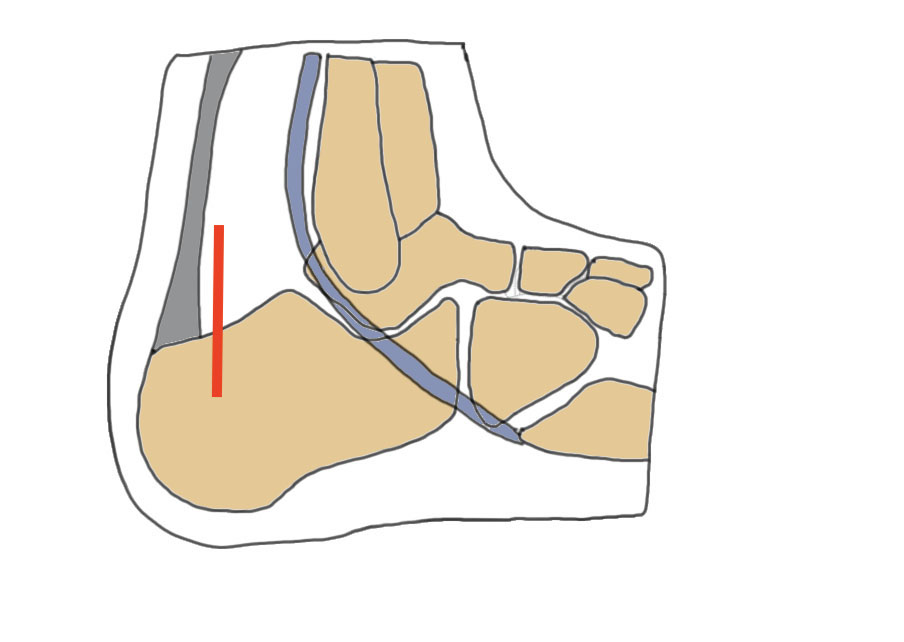 lateral approach calc