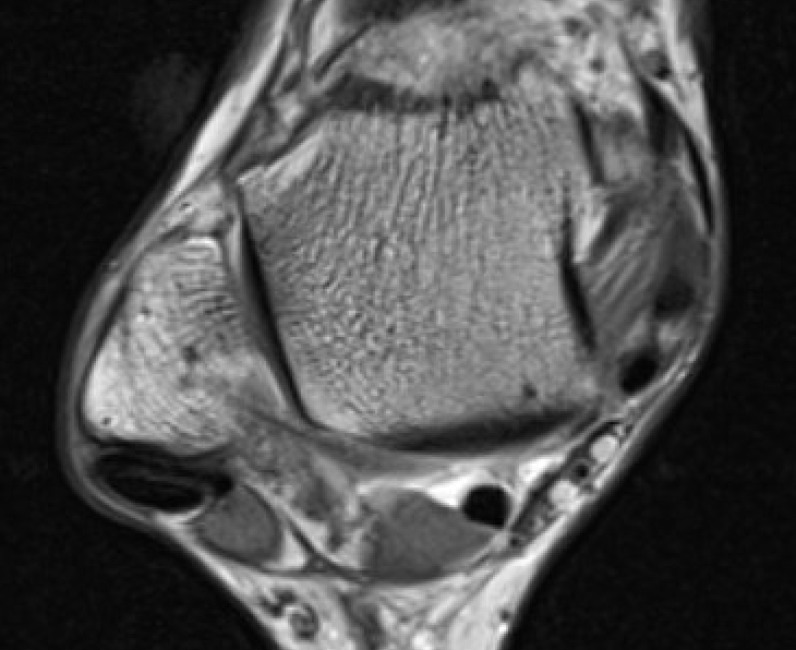 Tendinopathy