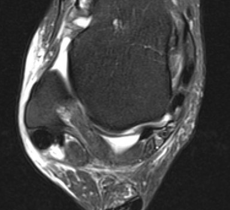 Tendinopathy