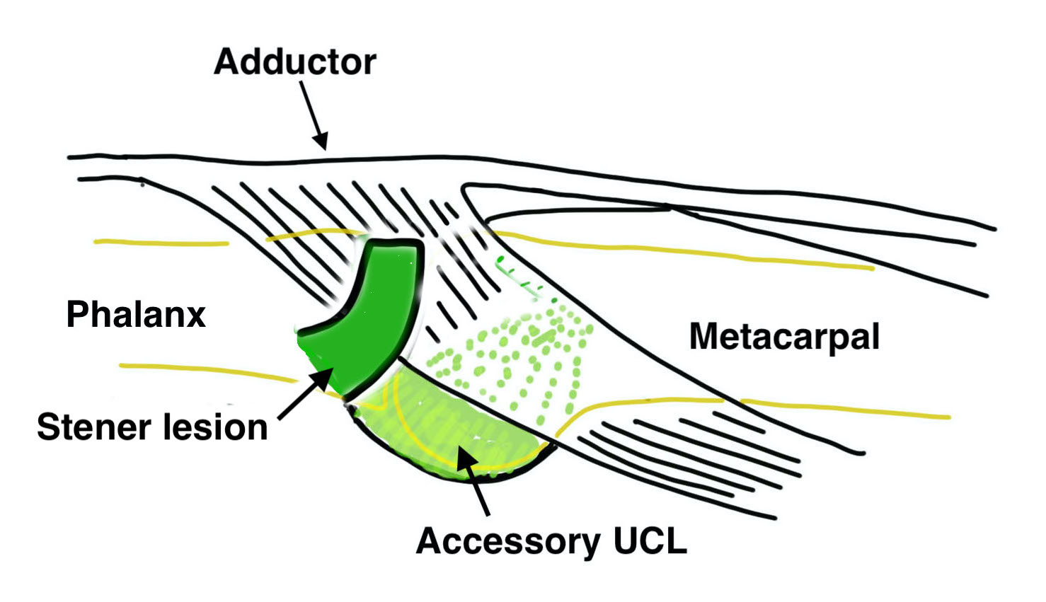 Stener lesion