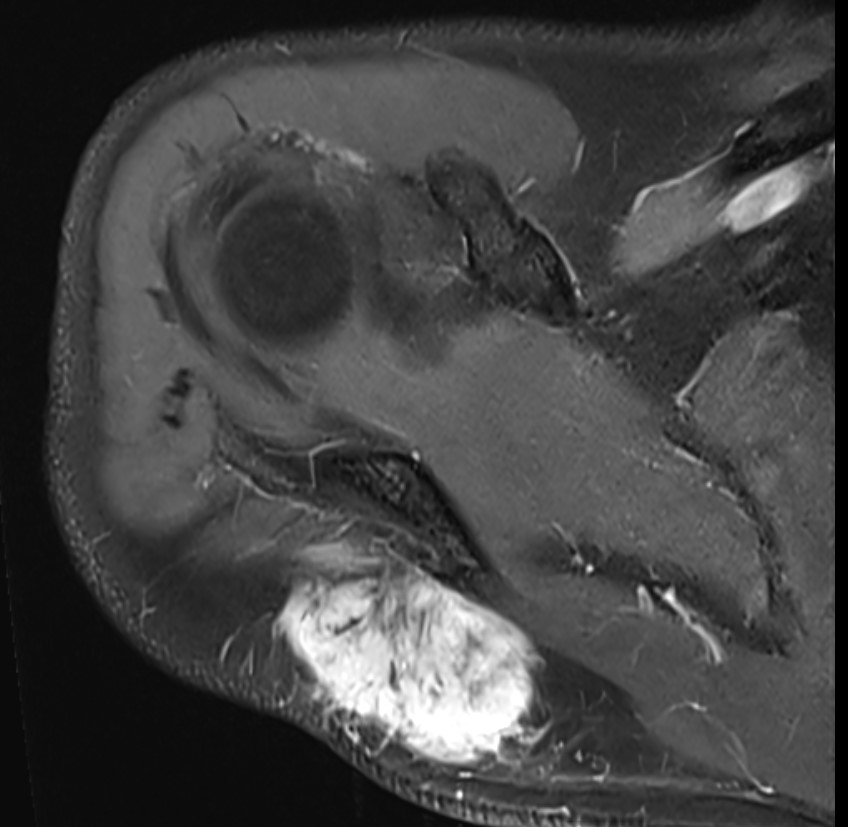 Desmoid MRI 3