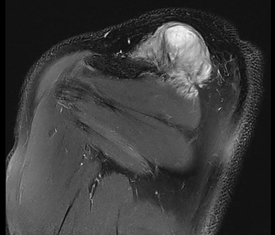 Desmoid MRI 1