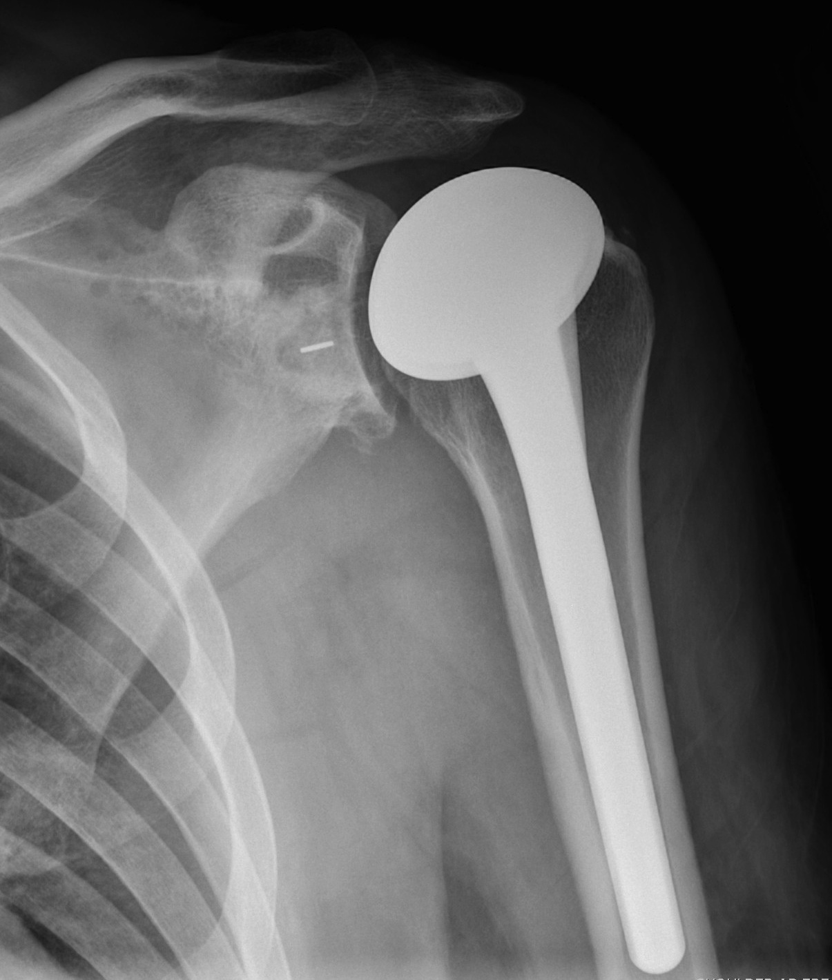 total shoulder arthroplast allPoly Glenoid