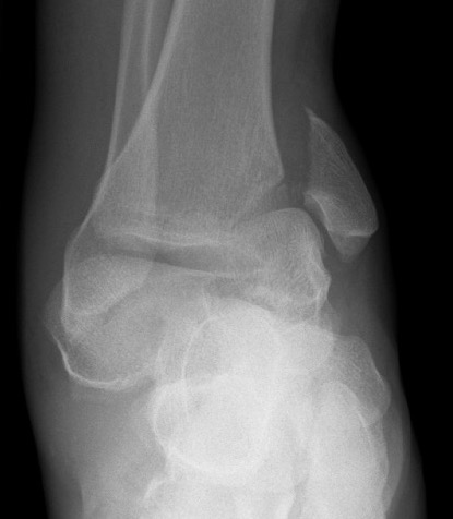 Talar body fracture