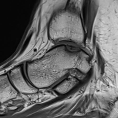 MRI OCD