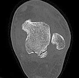 Posterior tuberosity fracture