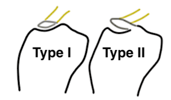 Tibial spine