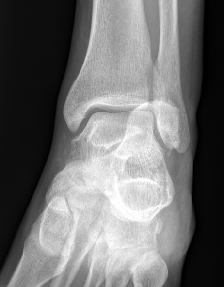 Tongue type calcaneum